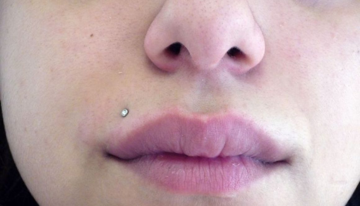 Herpes Simplex Virus - What the doctor says