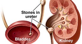 kidney stones