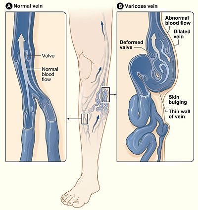 Varicose Vein Causes, Symptoms and Treatment