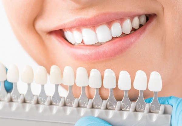 Factors That Need Consideration On Teeth Whitening Services